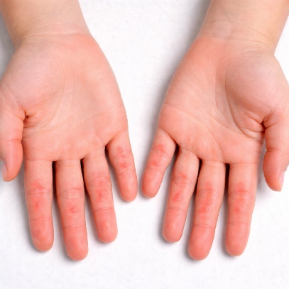 Dermatite da contatto al nichel sulle mani