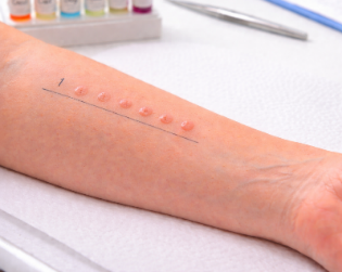 Immagine tratta dal documento DIAGNOSI ALLERGIE ALIMENTARI NEL NOSTRO STUDIO